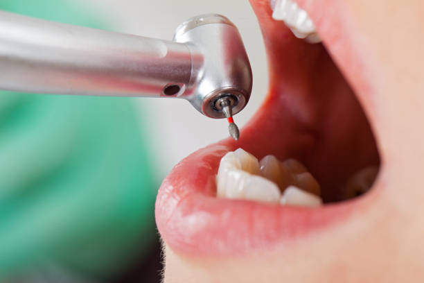 Best Emergency Tooth Extraction in Lake Orion, MI